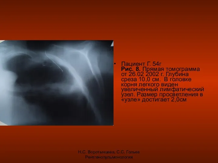 Н.С. Воротынцева, С.С. Гольев Рентгенопульмонология Пациент Г. 54г Рис. 8. Прямая