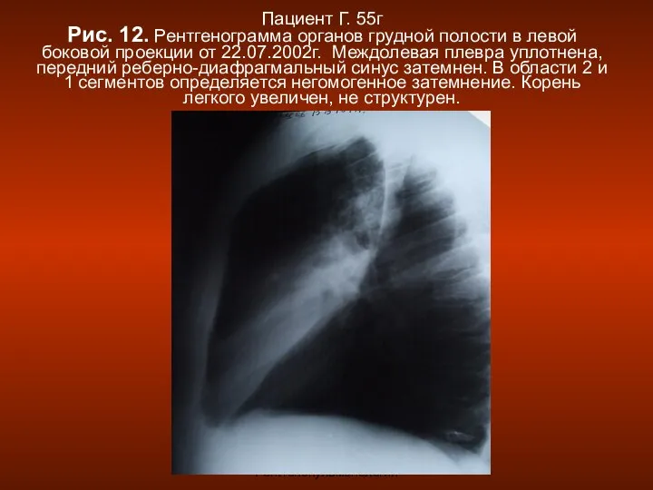 Н.С. Воротынцева, С.С. Гольев Рентгенопульмонология Пациент Г. 55г Рис. 12. Рентгенограмма