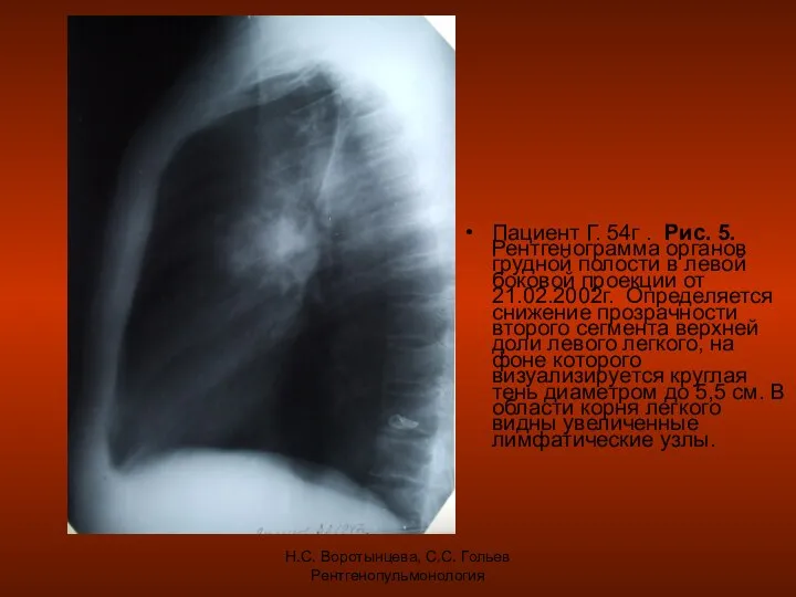 Н.С. Воротынцева, С.С. Гольев Рентгенопульмонология Пациент Г. 54г . Рис. 5.
