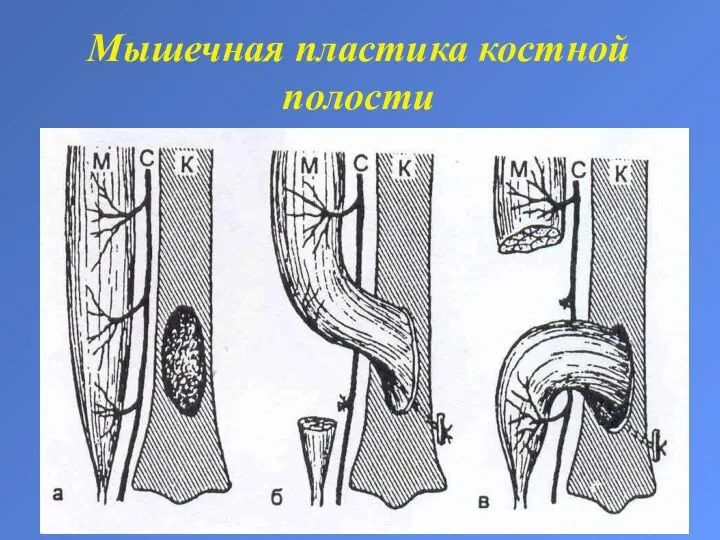 Мышечная пластика костной полости