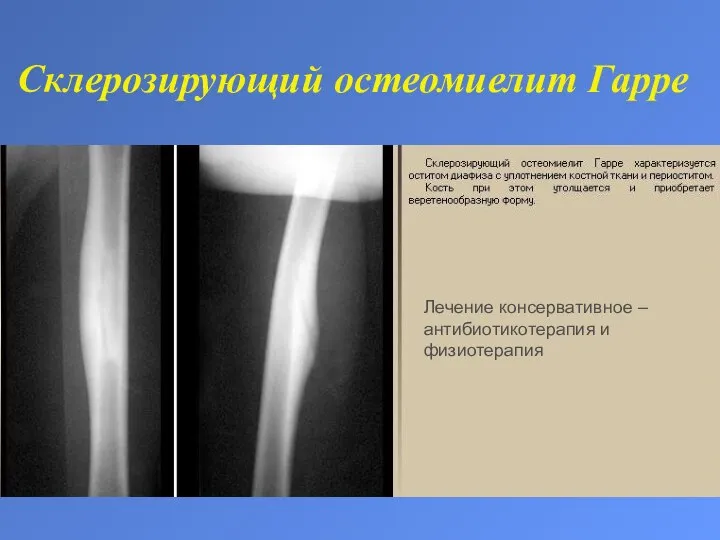 Склерозирующий остеомиелит Гарре Лечение консервативное – антибиотикотерапия и физиотерапия