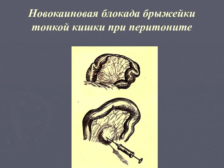 Новокаиновая блокада брыжейки тонкой кишки при перитоните