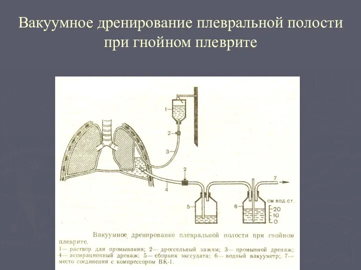 Вакуумное дренирование плевральной полости при гнойном плеврите