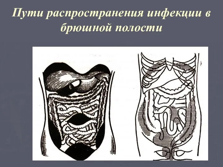 Пути распространения инфекции в брюшной полости