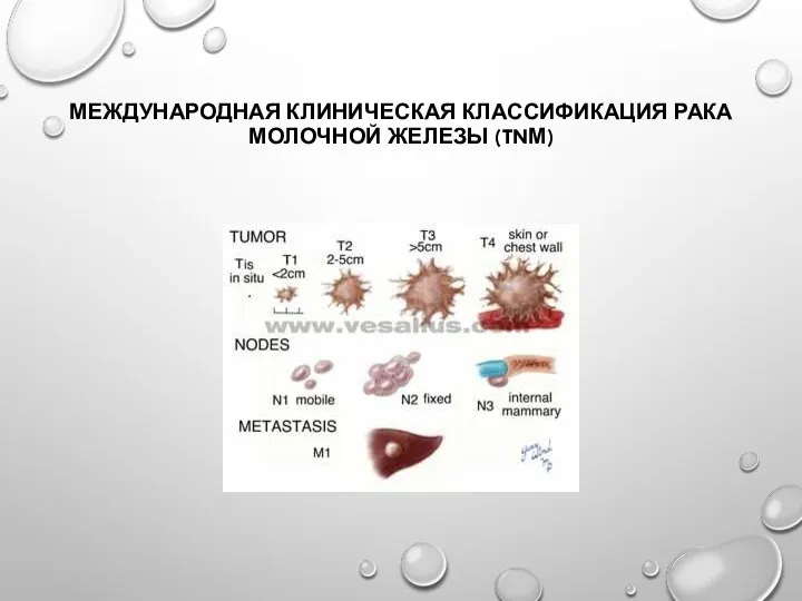 МЕЖДУНАРОДНАЯ КЛИНИЧЕСКАЯ КЛАССИФИКАЦИЯ РАКА МОЛОЧНОЙ ЖЕЛЕЗЫ (TNМ)