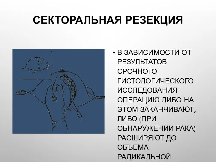 Секторальная резекция В зависимости от результатов срочного гистологического исследования операцию либо