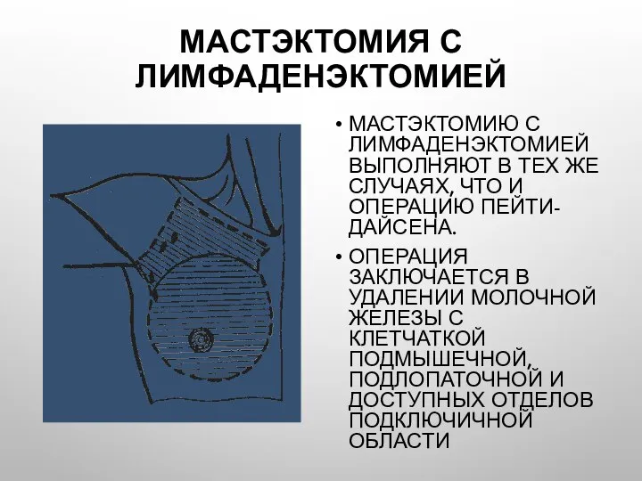 Мастэктомия с лимфаденэктомией Мастэктомию с лимфаденэктомией выполняют в тех же случаях,