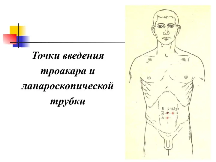 Точки введения троакара и лапароскопической трубки