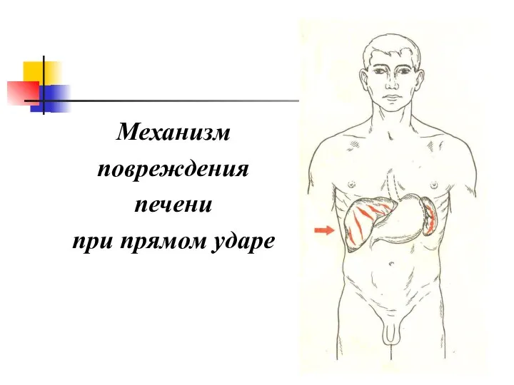 Механизм повреждения печени при прямом ударе