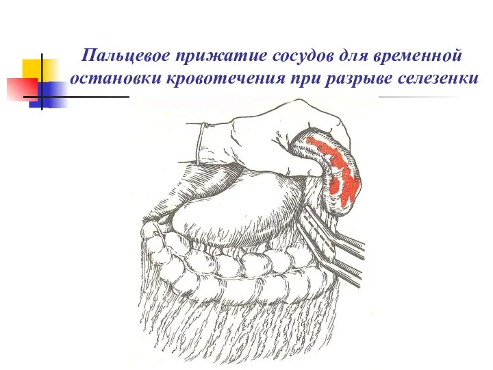 Пальцевое прижатие сосудов для временной остановки кровотечения при разрыве селезенки