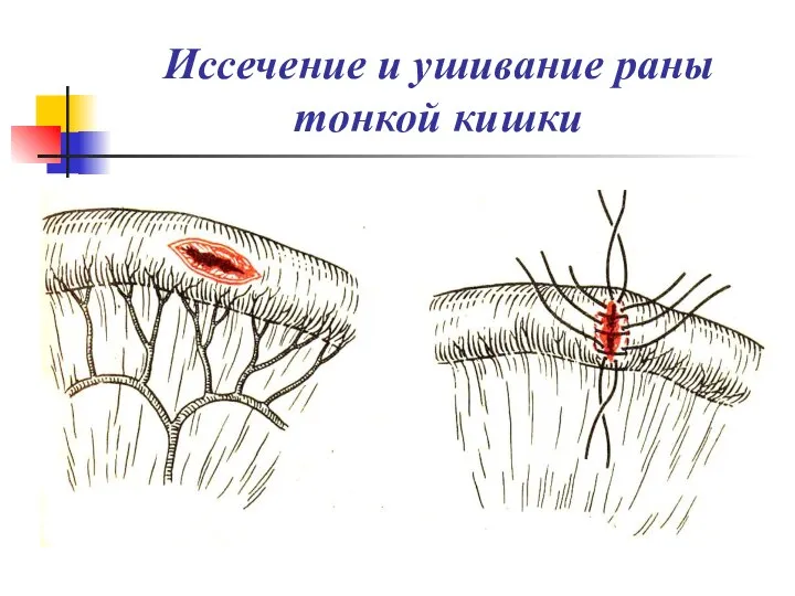 Иссечение и ушивание раны тонкой кишки