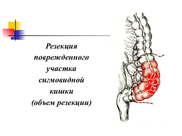 Резекция поврежденного участка сигмовидной кишки (объем резекции)