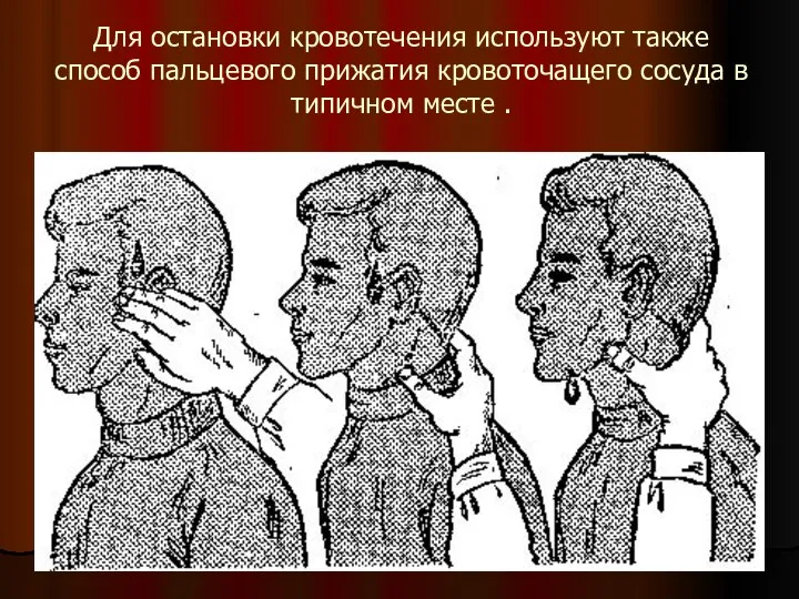 Для остановки кровотечения используют также способ пальцевого прижатия кровоточащего сосуда в типичном месте .