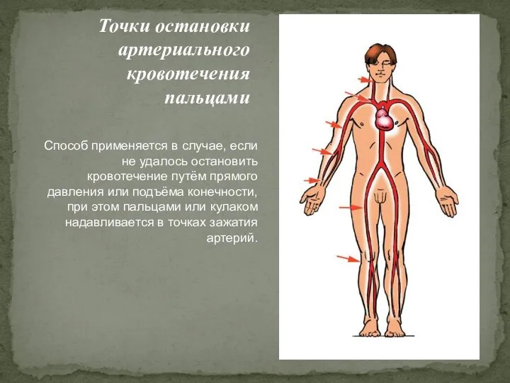 Точки остановки артериального кровотечения пальцами Способ применяется в случае, если не