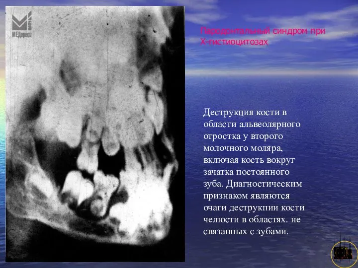 АНИСИМОВА Л.В.кмн. Деструкция кости в области альвеолярного отростка у второго молочного