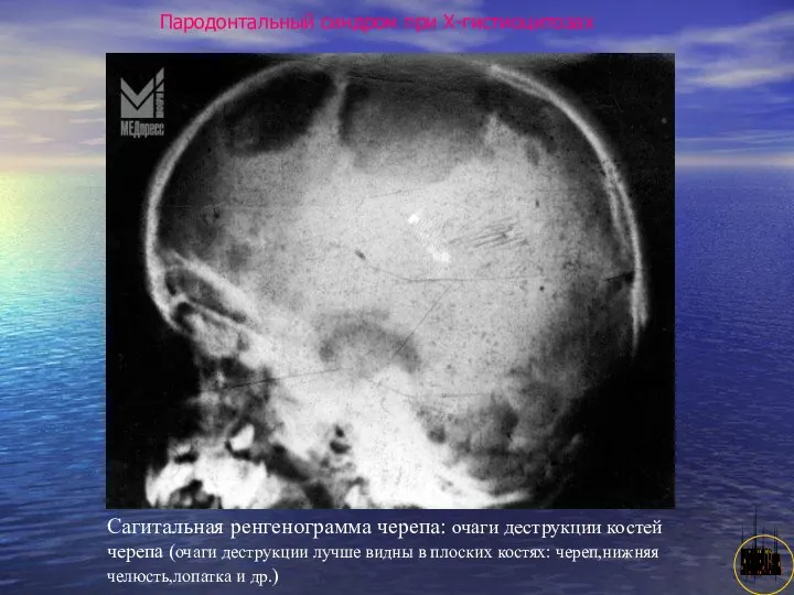 АНИСИМОВА Л.В.кмн. Пародонтальный синдром при Х-гистиоцитозах Сагитальная ренгенограмма черепа: очаги деструкции