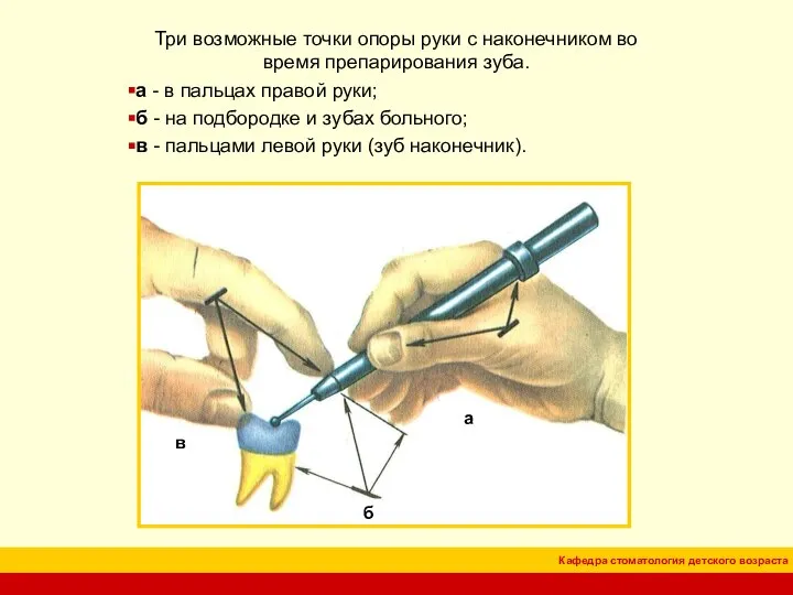 Три возможные точки опоры руки с наконечником во время препарирования зуба.