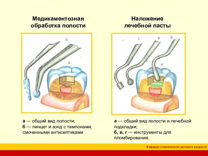 Медикаментозная обработка полости Наложение лечебной пасты а — общий вид полости;