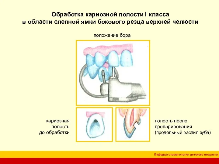 Обработка кариозной полости I класса в области слепной ямки бокового резца