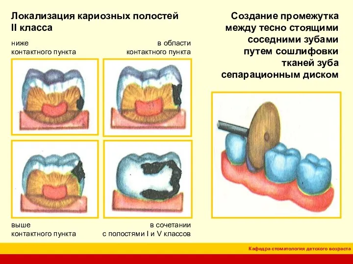 Локализация кариозных полостей II класса в области контактного пункта ниже контактного