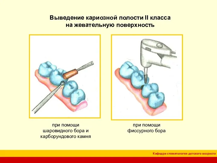 Выведение кариозной полости II класса на жевательную поверхность при помощи фиссурного