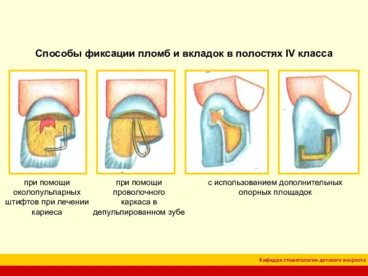 Способы фиксации пломб и вкладок в полостях IV класса при помощи