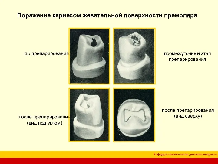 Поражение кариесом жевательной поверхности премоляра до препарирования промежуточный этап препарирования после