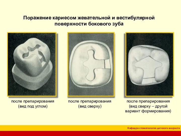 после препарирования (вид под углом) после препарирования (вид сверху) Поражение кариесом