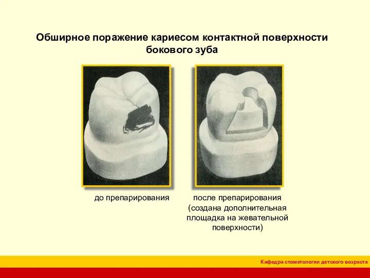 Обширное поражение кариесом контактной поверхности бокового зуба до препарирования после препарирования