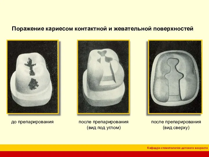 Поражение кариесом контактной и жевательной поверхностей до препарирования после препарирования (вид