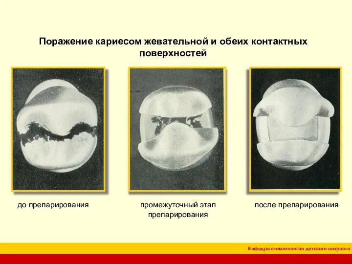 Поражение кариесом жевательной и обеих контактных поверхностей до препарирования промежуточный этап препарирования после препарирования