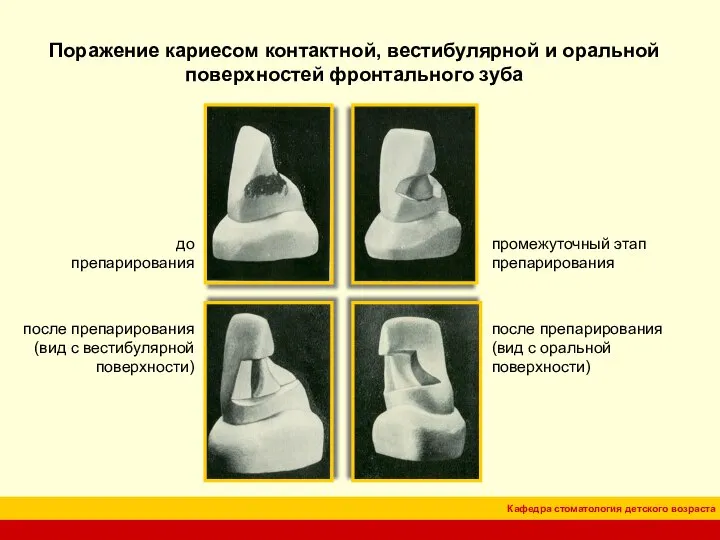 Поражение кариесом контактной, вестибулярной и оральной поверхностей фронтального зуба до препарирования