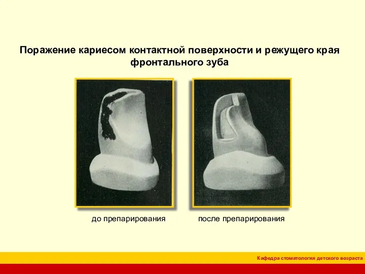 Поражение кариесом контактной поверхности и режущего края фронтального зуба до препарирования после препарирования