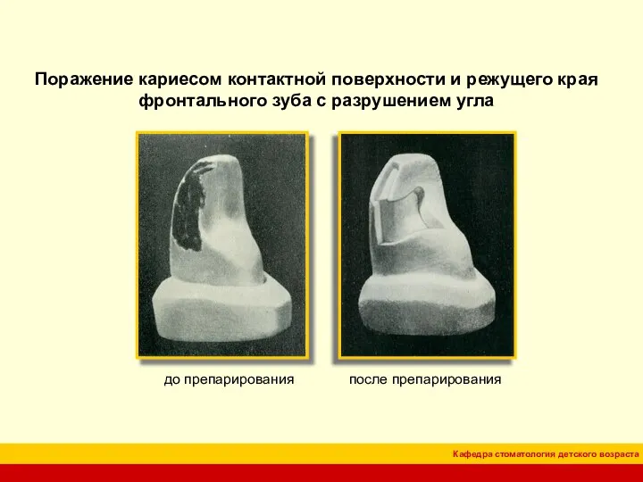 Поражение кариесом контактной поверхности и режущего края фронтального зуба с разрушением угла до препарирования после препарирования