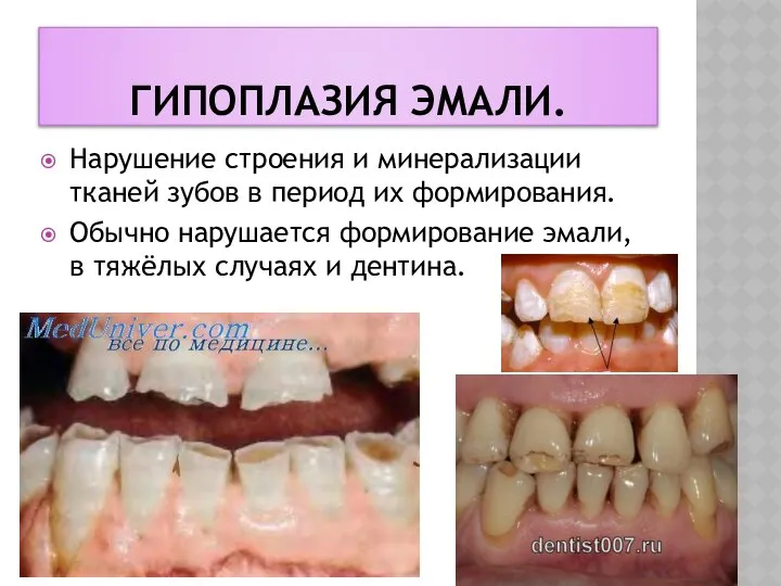 Гипоплазия эмали. Нарушение строения и минерализации тканей зубов в период их