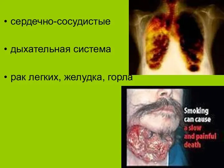 Заболевания курильщиков сердечно-сосудистые дыхательная система рак легких, желудка, горла