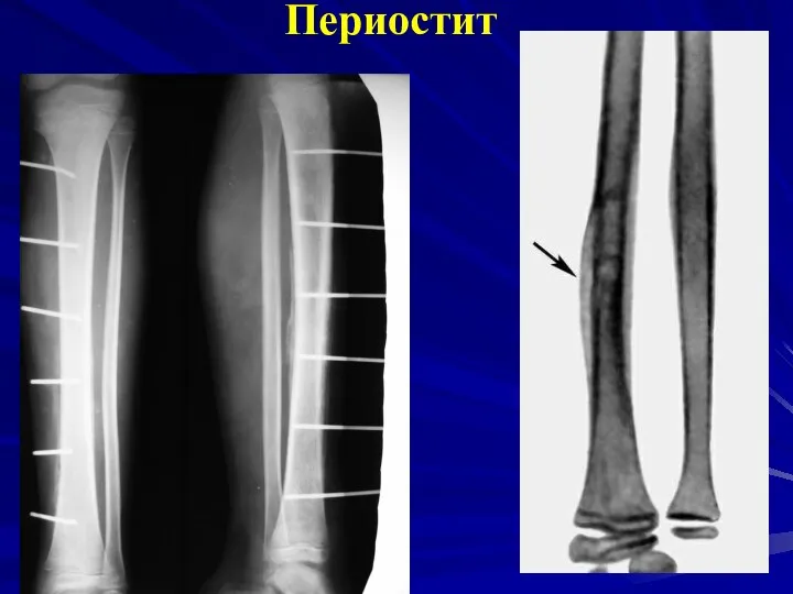 Периостит