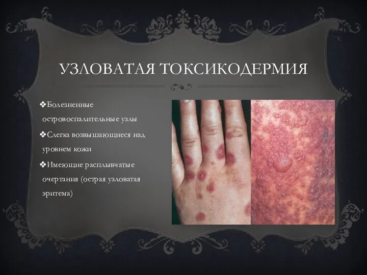 Болезненные островоспалительные узлы Слегка возвышающиеся над уровнем кожи Имеющие расплывчатые очертания (острая узловатая эритема) узловатая токсикодермия