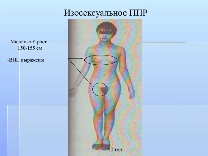 Изосексуальное ППР Маленький рост 150-155 см 10 лет ВПП выражены