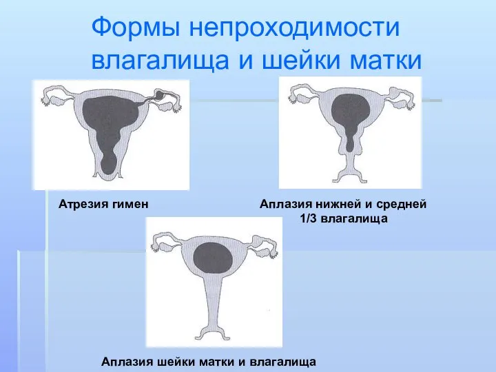 Формы непроходимости влагалища и шейки матки Атрезия гимен Аплазия шейки матки