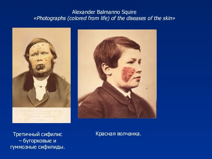 Третичный сифилис – бугорковые и гуммозные сифилиды. Alexander Balmanno Squire «Photographs