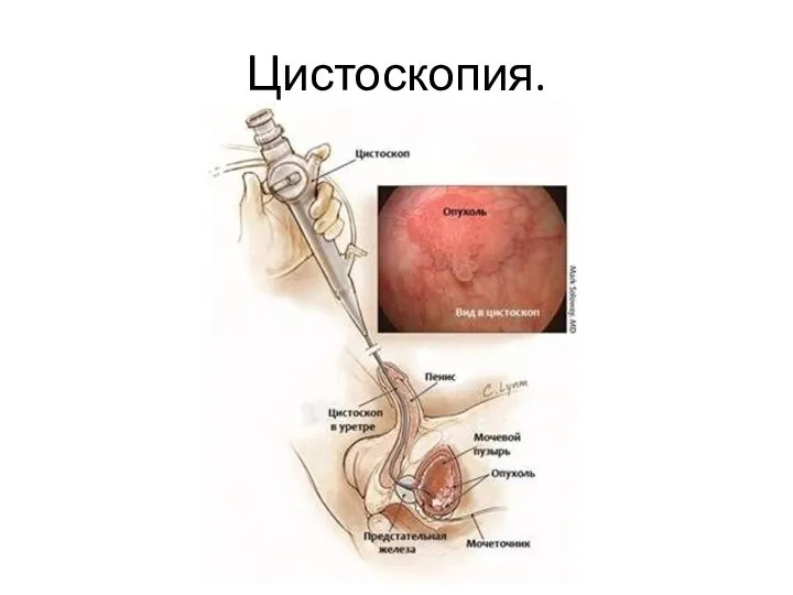 Цистоскопия.