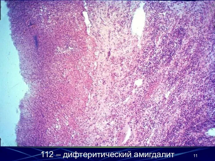 112 – дифтеритический амигдалит