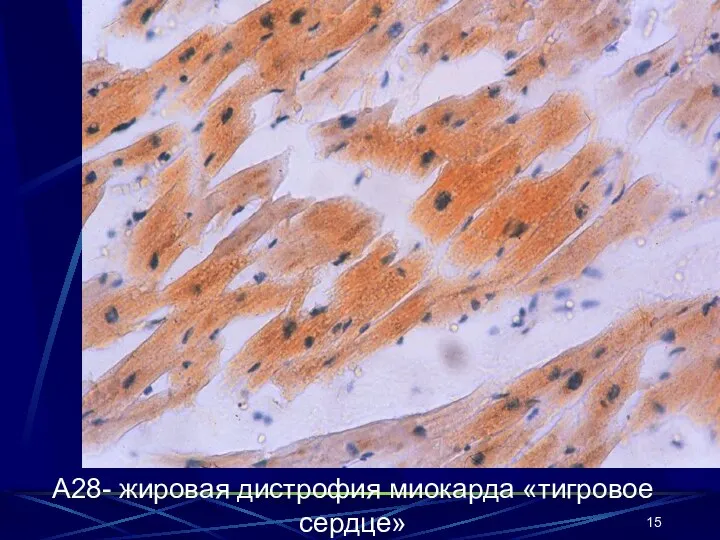 А28- жировая дистрофия миокарда «тигровое сердце»