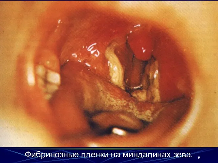 Фибринозные пленки на миндалинах зева.