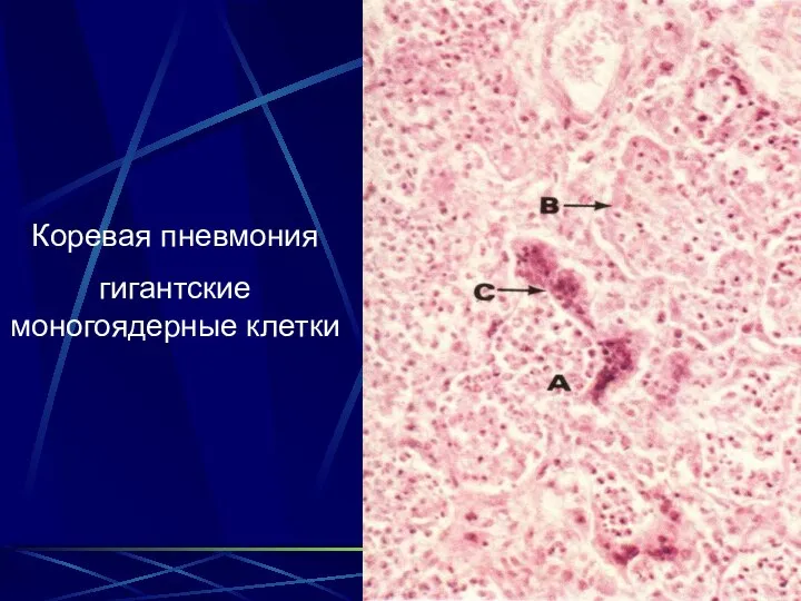 Коревая пневмония гигантские моногоядерные клетки