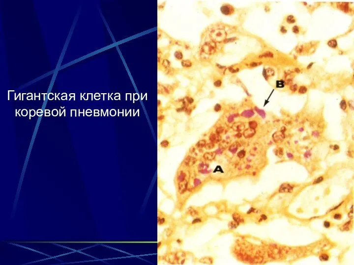 Гигантская клетка при коревой пневмонии