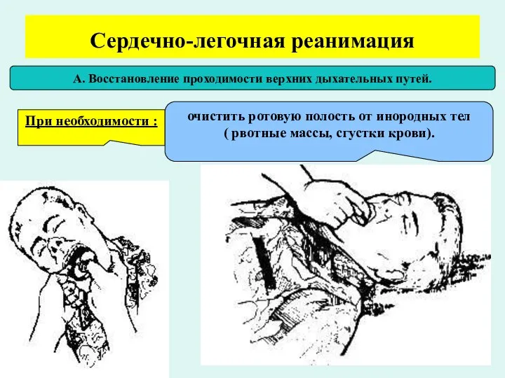 Сердечно-легочная реанимация А. Восстановление проходимости верхних дыхательных путей. При необходимости :