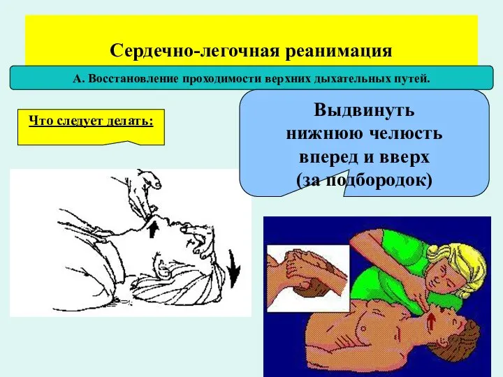 Сердечно-легочная реанимация А. Восстановление проходимости верхних дыхательных путей. Что следует делать: