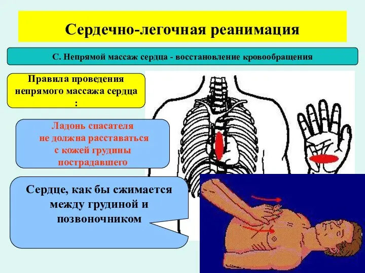 Сердечно-легочная реанимация С. Непрямой массаж сердца - восстановление кровообращения Правила проведения